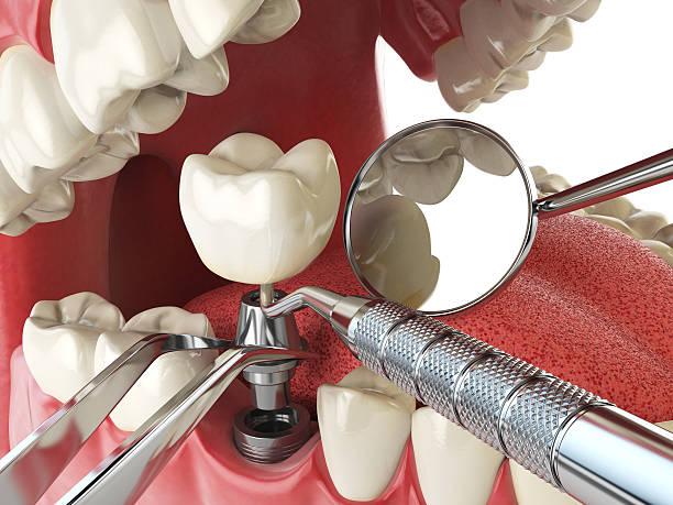 Best Broken or Cracked Tooth Emergency Dentist in Nashville, TN